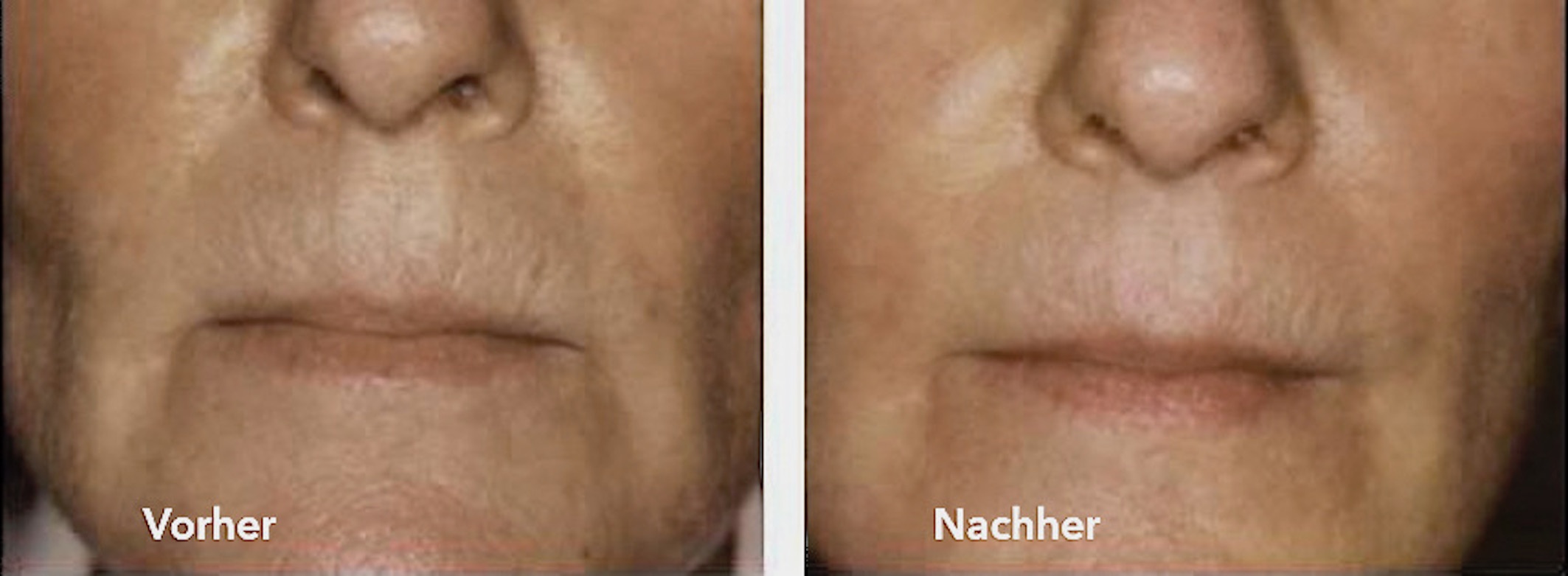Vorher/Nachher Bilder nach Behandlung mit Proteos Plus Cocktail - Microneedling Serum