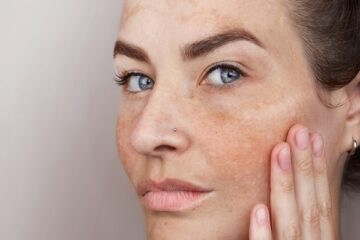 Frau mit Pigmentflecken im Gesicht